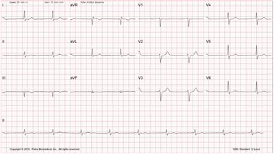 Dilated cardiomyopathy due to novel LMNA mutation: a case report